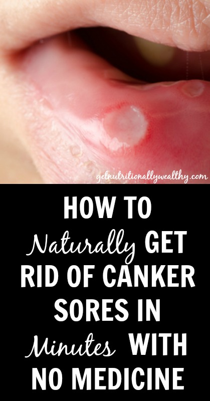 How To Naturally Get Rid of Canker Sores | nutritionallywealthy.com