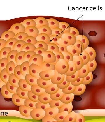 Scientists Convert Cancer Cells Into Harmless Immune Cells